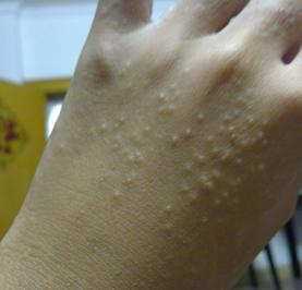 汗疱疹的症状是什么？怎么治比较好？