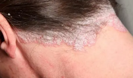 福州市皮肤病研究所-有效的药膏治疗头癣的方法